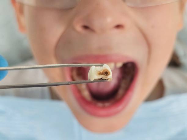 Best Emergency Tooth Extraction in Fairfax, CA